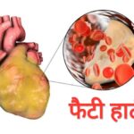 फैटी हार्ट के लक्षणों को न करें इग्नोर! (डायटीशियन अमृता)