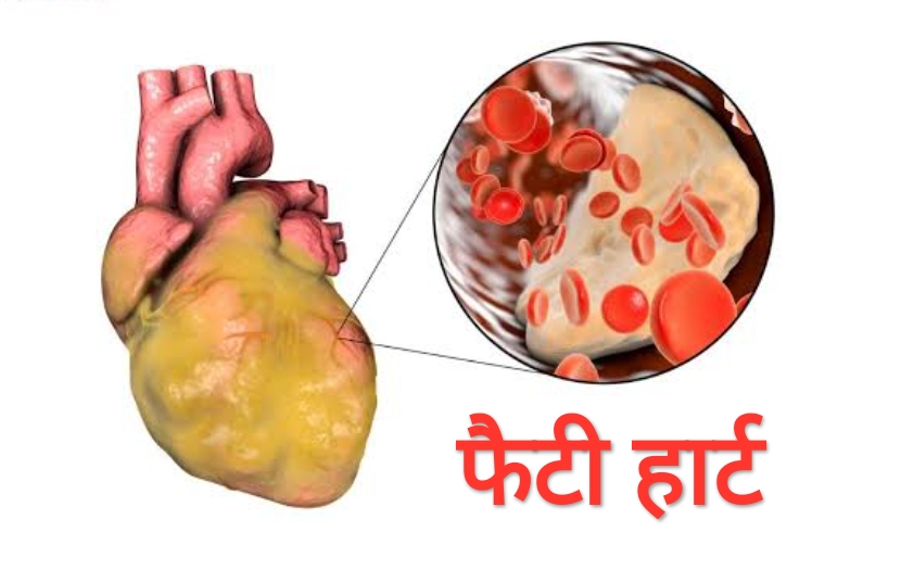 फैटी हार्ट के लक्षणों को न करें इग्नोर! (डायटीशियन अमृता)