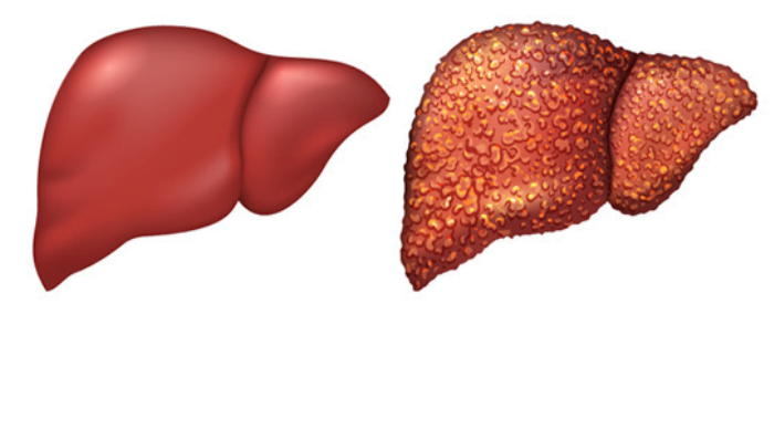 फैटी लिवर से बचने के लिए कौन से फूड्स खाएं? 