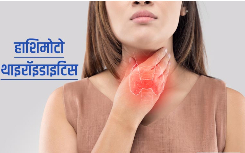 हाशिमोटो का थायरॉयडिटिस लक्षण, कारण और उपचार! (डायटीशियन अमृता)