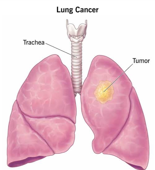 फेफड़ों का कैंसर: डायग्नोसिस और इलाज