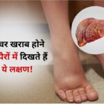 पैरों में दिखाई देने वाले लक्षणों को न करें नजरअंदाज़, खराब हो रहा आपका लिवर ! (डायटीशियन अमृता)