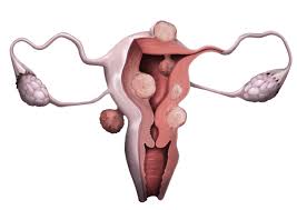 यूट्रस में फाइब्रॉएड के लिए सबसे खराब खाना