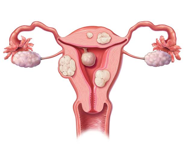यूट्रस में फाइब्रॉएड को कम करने के लिए खाने की चीज़ें