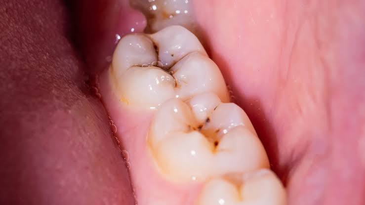 दांतों की सड़न के कारण और लक्षण