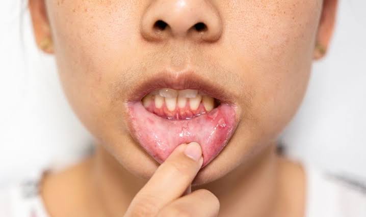 मुंह के छालों के इलाज के लिए प्राकृतिक उपाय