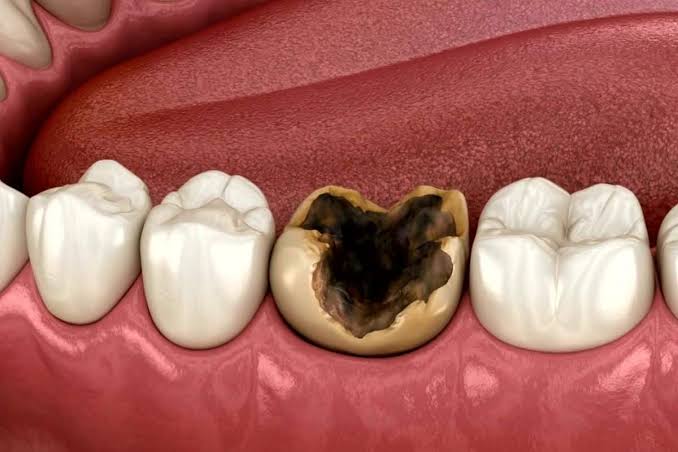 दांतों की सड़न के कारक और रोकथाम