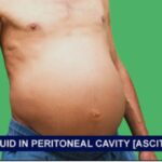 नॉन-अल्कोहलिक एसाइटिस! कारण, लक्षण और उपचार।