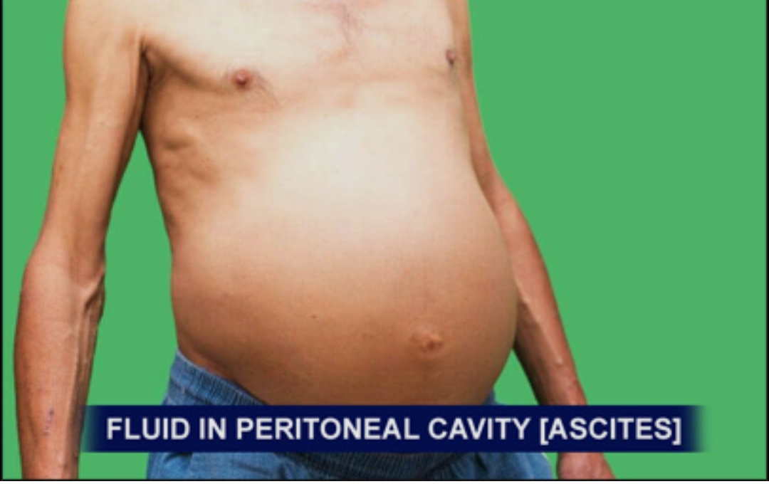 नॉन-अल्कोहलिक एसाइटिस! कारण, लक्षण और उपचार।