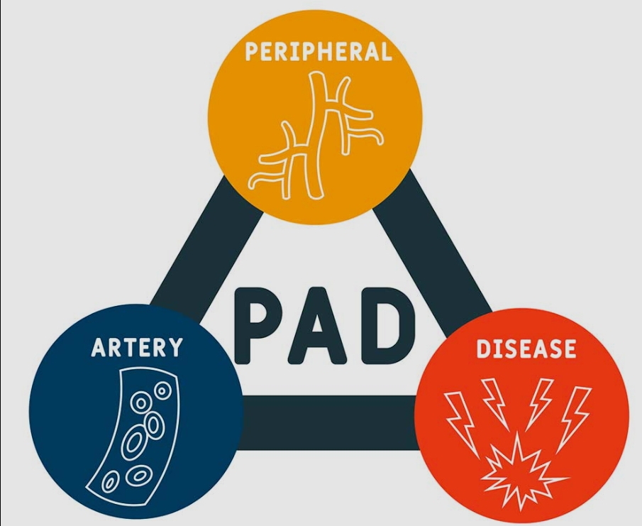 “पेरिफेरल आर्टरी डिजीज”, इस जानलेवा बीमारी के कारण, लक्षण और बचाव!