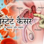 प्रोस्टेट कैंसर का इलाज संभव, फिर भी देर से समझ आते हैं लक्षण!