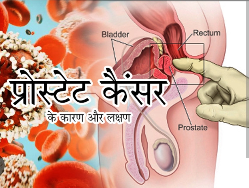प्रोस्टेट कैंसर का इलाज संभव, फिर भी देर से समझ आते हैं लक्षण!